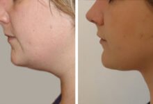 Double Chin Removal in Dubai