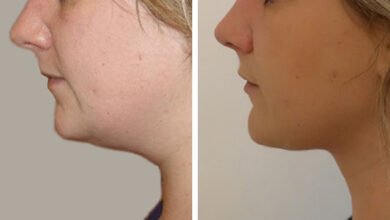 Double Chin Removal in Dubai