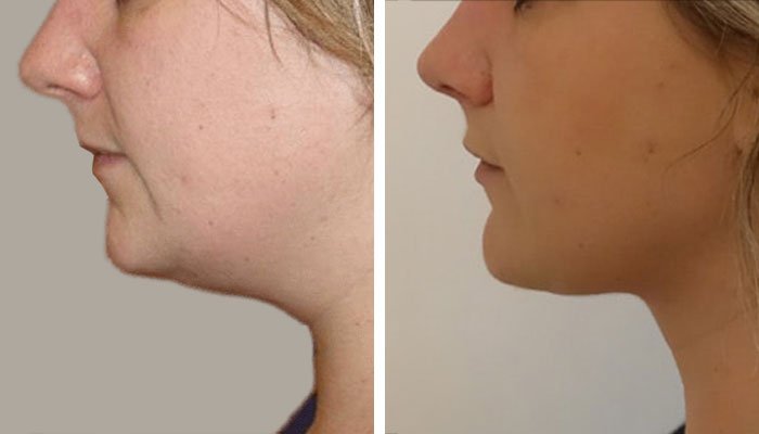 Double Chin Removal in Dubai